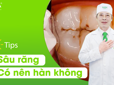 Có nên hàn răng không
